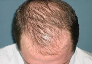 cauzele caderii parului