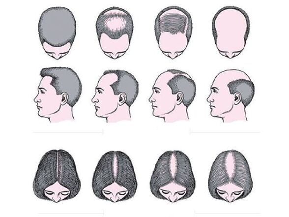 Alopecia androgenetică la bărbați și femei