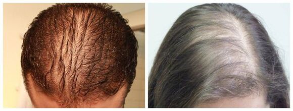 Alopecie difuză