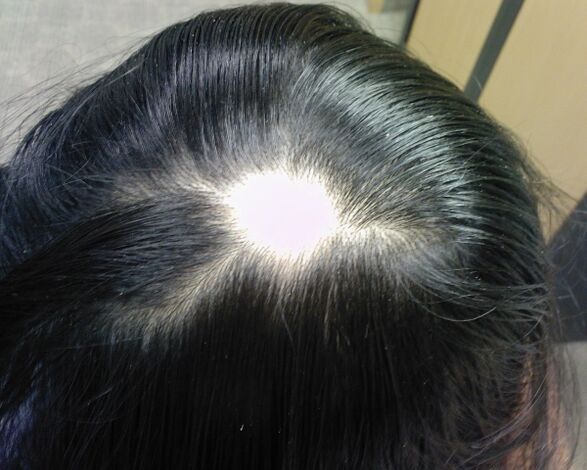 Alopecia areata sau alopecia areata la femei