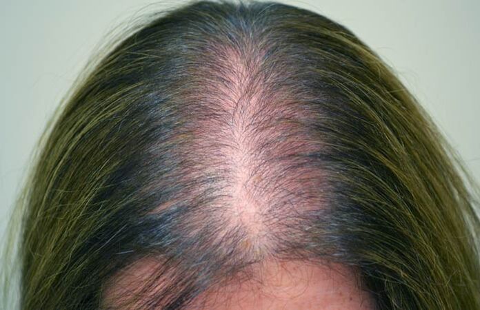 Alopecie (chelie) la femei