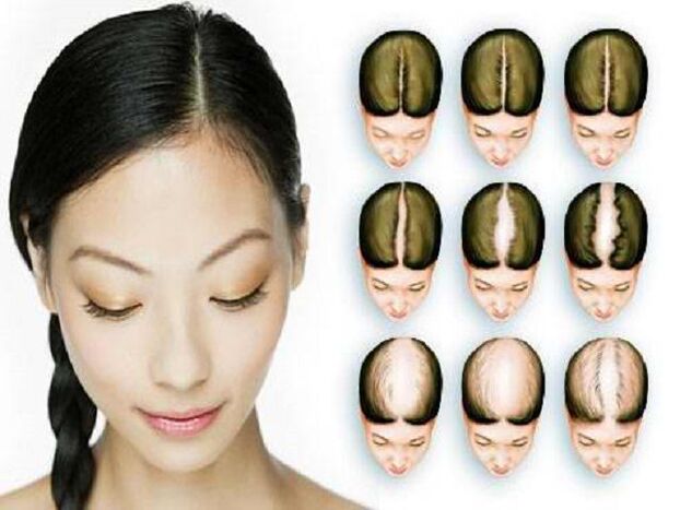 Stadiile alopeciei la femei