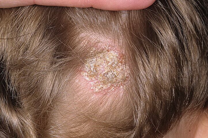 Tipul seboreic de alopecie la femei
