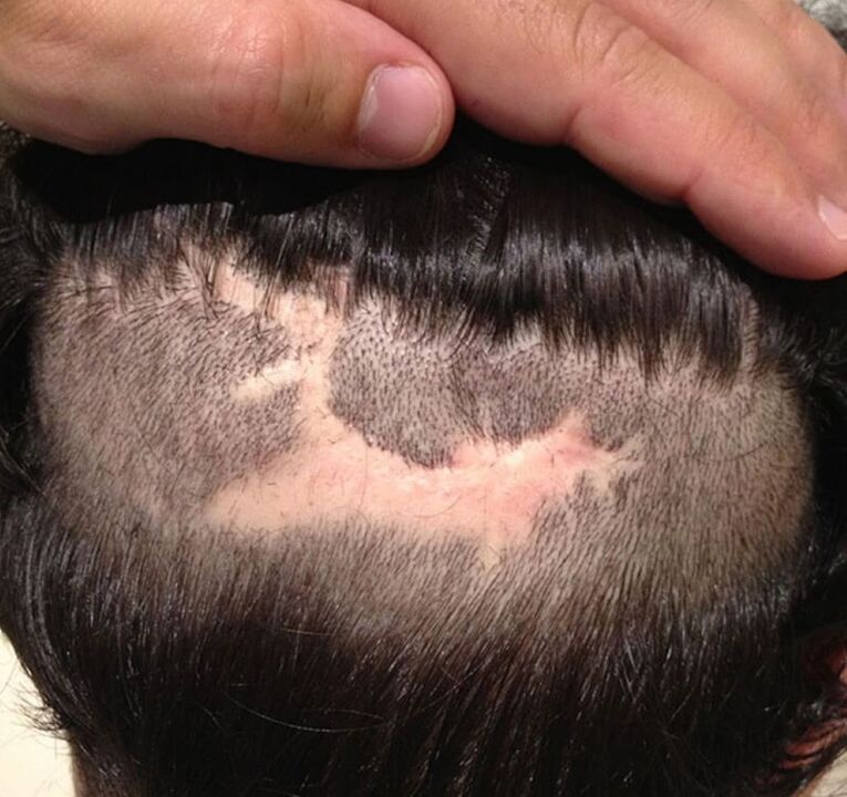 alopecie cicatricială a scalpului