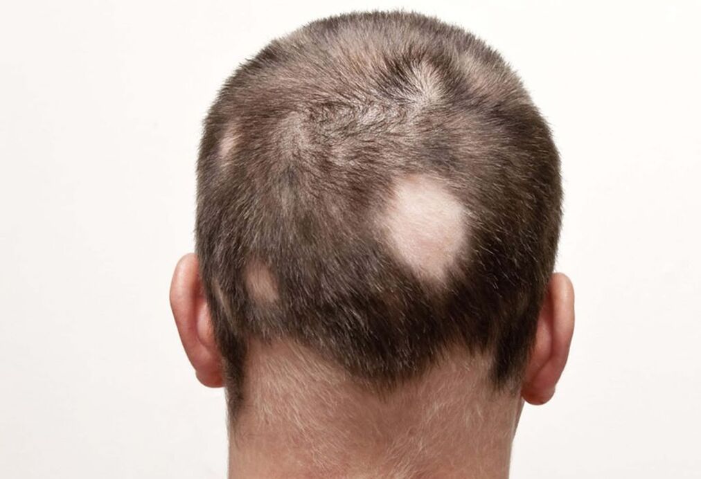 alopecie de cuib (focal) a capului
