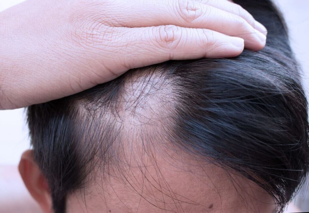 alopecie difuză a capului