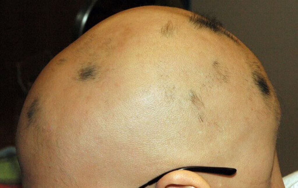 alopecie totală a scalpului la un bărbat