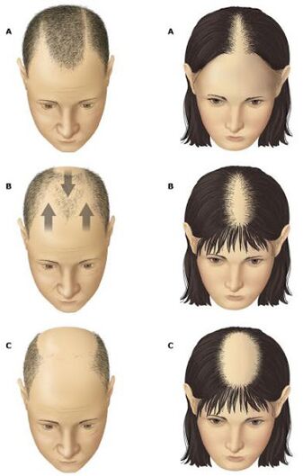 Alopecia androgenă la bărbați și femei