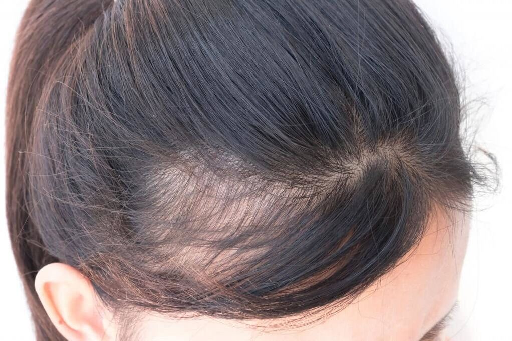 Alopecia androgenă la femei