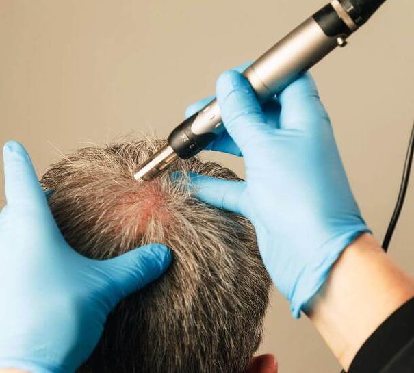 Fizioterapie pentru tratamentul alopeciei androgenice