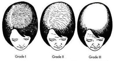 Grade de chelie androgenă feminină
