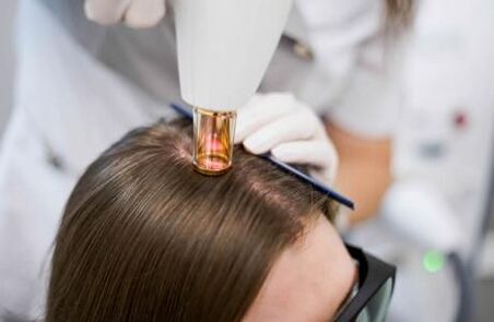 Terapia cu laser pentru alopecia androgenetică