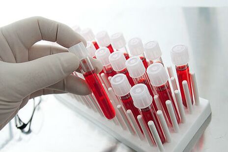 Test de sânge pentru a prescrie tratament individual pentru alopecie